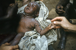 This photograph, taken during CDCs Nigerian relief effort in the late 1960s, shows a Nigerian child suffering from smallpox while visiting a refugee camp during the Biafran war.Smallpox was a constant so most children were vaccinated for smallpox, measles and pertussis upon entering the camps. Camps in the northern sector of Enugu had the highest number of smallpox cases. Note in this photograph, a local treatment of an antipruritic lotion was applied to relieve the itching, pain, and discomfort. /Dr. Lyle Conrad JLConrad collection - Folder 2, Slide 029 CD_102_DH/ 088 http://www.bt.cdc.gov/agent/smallpox/index.asp CDC  Emergency Preparedness & Response; Smallpox  Information for Specific Groups http://www.cdc.gov/eis/index.htm CDC - Epidemic Intelligence Service (EIS), Epidemiology Program Office